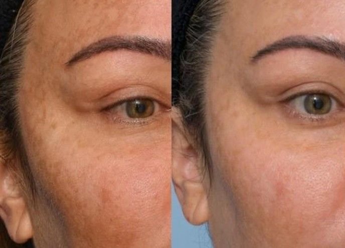 Before and after result 4