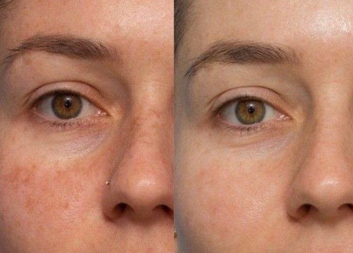 Before and after result 5