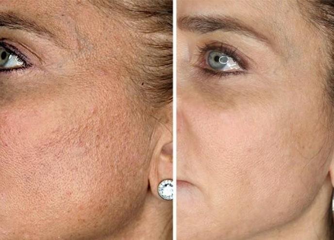Before and after result 1