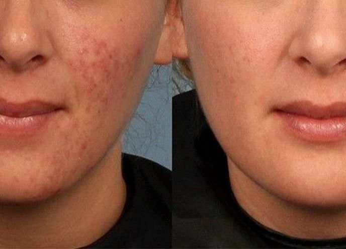 Before and after result 2