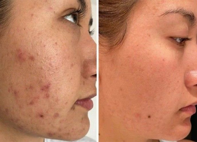 Before and after result 3